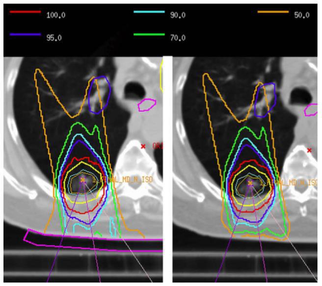 RADIATION THERAPY FOR STAGE I NON-SMALL-CELL LUNG