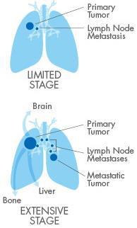 SCLC: Limited stage Stage I III (T any, N any, M0) α ι οθ α ύσι ο αι ού αι T3/4 ο α ά ο ί ια αι bulky φα ο άθ ια