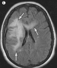 Natalizumab (Tysabri) anti integrin a4 (μόριο προσκόλλησης) Κατά πλάκας σκλήρυνση και ν. Crohn 2004 έγκριση 2004 απόσυρση 2006 νέα έγκριση 31 περιπτώσεις PML ~1:1000 Kleinschmidt De Masters BK.