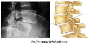 Αίτια οσφυαλγίας Μηχανικά αίτια Μυοσυνδεσμική βλάβη Οστεοαρθρίτιδα ΟΜΣΣ Κήλη μεσοσπονδυλίου δίσκου Σπονδυλολίσθηση Στένωση του