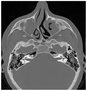 Παραρρίνια One airway One disease Καθολική προσβολή η ένταση των συμπτωμάτων ποικίλει Ρινικοί πολύποδες στο 30-45% τάση υποτροπής μετά από εκτομή Η μικροβιολογία αντανακλά