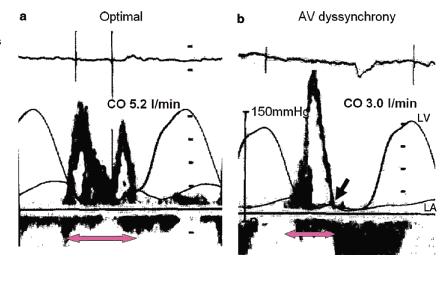 AV mechanical dyssynchrony