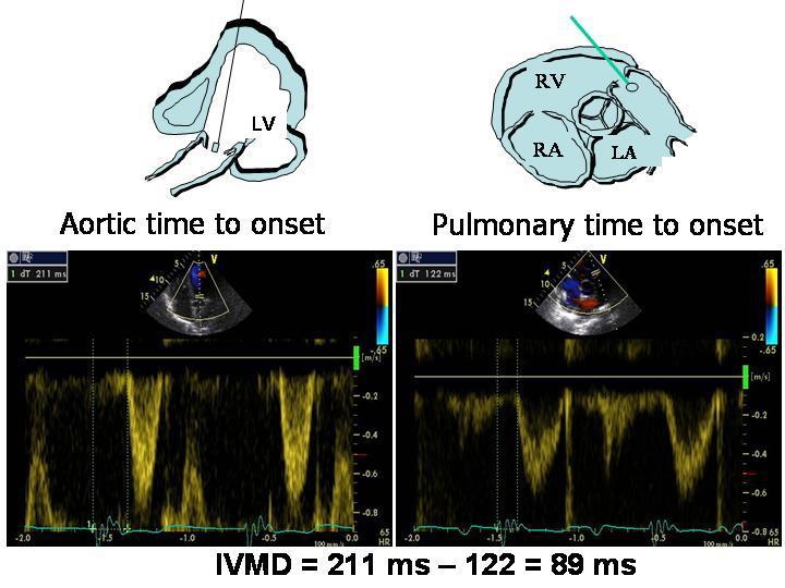 Intraventricular mechanical IVMD values of > 40 ms and values