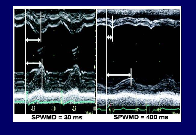 Inter-ventricular mechanical