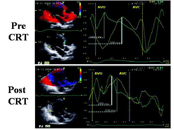 Inter-ventricular