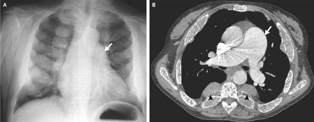 Aessopos A, Circulation, 201122:1227-32 Aessopos A et al, Eur J Haematol 2008;80:93 106 Voskaridou E