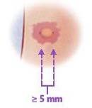 Διάγνωση (IΙ) HIV λοίμωξη Πρόσφατη επαφή με κρούσμα ενεργού ΤΒ Ινωτικές βλάβες