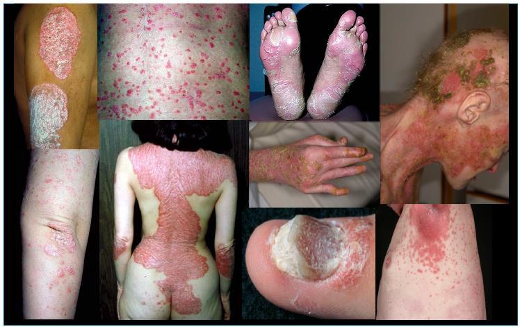 Mrowietz et al, Experimental Dermatology, 2014,