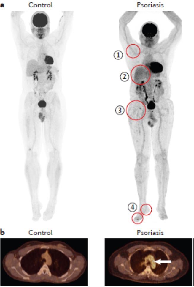 Θεραπεύουμε την δερματική νόσο ή τον ασθενή? PET scan Εστίες φλεγμονής U. Mrowietz et al, Experimental Dermatology, 2014, 23, 705 709. 1.
