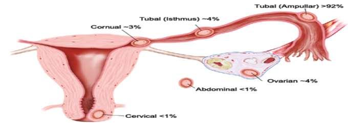 شکل 0 : محلهای بروز حاملگی نا به جا حاملگی در قسمت بینابینی: النه گزینی در قسمتی از لوله که دیواره رحم را سوراخ می کند سبب حاملگی بینابینی )Interstitial( یا شاخی )Cornual( میشود.