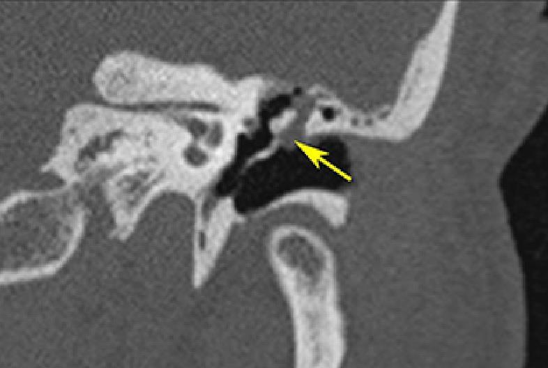 Компјутеризована томографија (CT) темпоралних костију и/или магнетна резонанца (MR) главе су неопходни код рецидива стеченог холестеатома или код сумње на отогену компликацију.