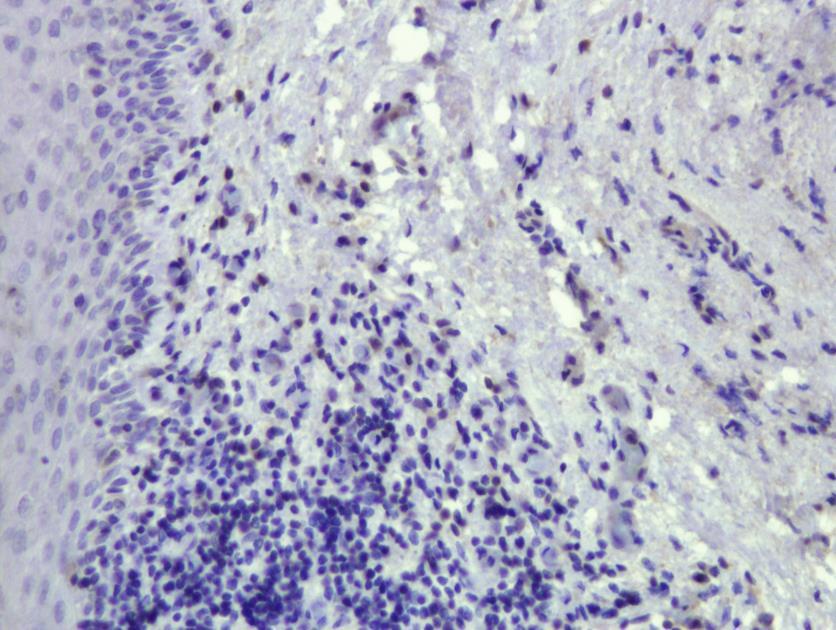 холестеатома CD4 лимфоцитима (увеличање 200х). Слика 27.