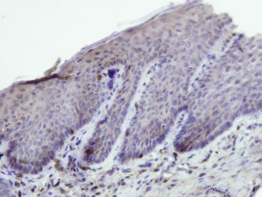 Експресија CD4 лимфоцита је била углавном слабо до умерено изражена у узорцима коже спољашњег слушног ходника уз предоминацију субепителног распорада CD4+ ћелија, док је у кожи