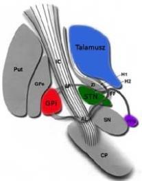 Chirurgické ciele pre PCH VIM thalamus Redukcia tremoru Minimálny efekt na bradykinézu a rigiditu Globus pallidus internus -