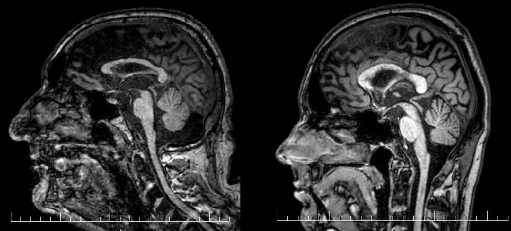 Zobrazovacie vyšetrenia MRI príznak