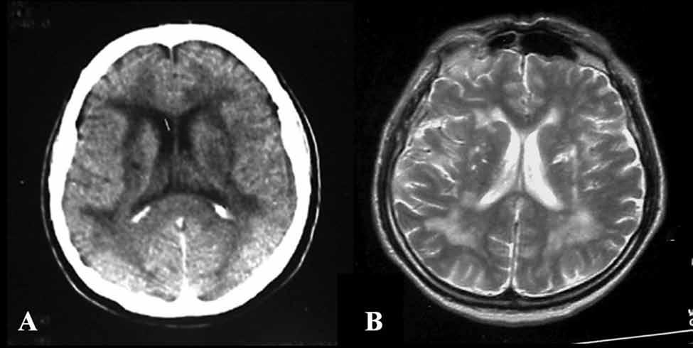 251 Слика 1. А) Налаз компјутеризоване томографије мозга, конфлуентне исхемијске лезије беле масе и више лакунарних исхемија.