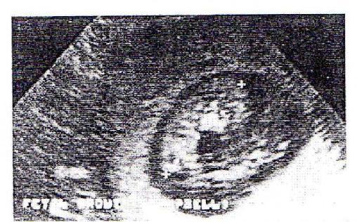 Μέτρηση του κεφαλουραιου άξονα τον εμβρύου για προσδιορισμό της ηλικίας της κύησης Έμβρυο 11 εβδομάδων. 3.