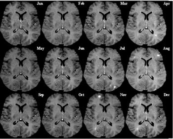 12. Πολλαπλή σκλήρυνση Εικόνα 6 Μαγνητική τομογραφία του ίδιου σημείου στον εγκέφαλο ανά μήνα που δείχνει πολλαπλή σκλήρυνση. Τα φωτεινά σημεία είναι εκεί που η μυελίνη έχει καταστραφεί.