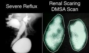 Το DMSA scanning,5-6 μήνες μετά το επεισόδιο ΟΥΛ θα πρέπει να διενεργείται σε παιδιά κάθε ηλικίας με: 1. Πρώτο επεισόδιο εμπύρετης ΟΥΛ και ΚΟΠ ΙΙΙ βαθμού 2. Σοβαρή κλινική εικόνα εμπύρετης ΟΥΛ 3.