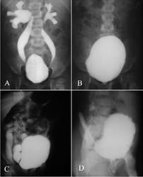 Ασταθής κύστη (unstable bladder) Δυσυνεργική κύστη (discoordinated bladder) η