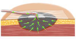 ΜΗΧΑΝΙΚΟΣ (vacuum assisted closure V.A.