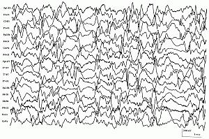 Βρεφικοί σπασµοί - σύνδροµο West i. επιληπτικοί σπασμοί (καμπτικοί, μικτοί, εκτατικοί) σε ομάδες (20-100, διάρκεια μ.ο. 5-10 λεπτά), στην αφύπνιση ή στην έναρξη του ύπνου ii.
