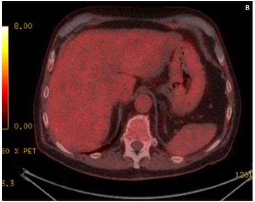 Tacrolimus+ MMF 5 ο χρόνο αδενοκαρκίνωμα δωδεκαδακτύλου με εντερική