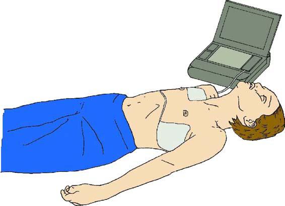 European Resuscitation Council Guidelines for Resuscitation 2005 13 Všeobecné znaky FBAO Epizóda pozorovaná svedkami Kašeľ/dusenie sa Náhly začiatok Údaj o nedávnej hre s/jedení malých objektov
