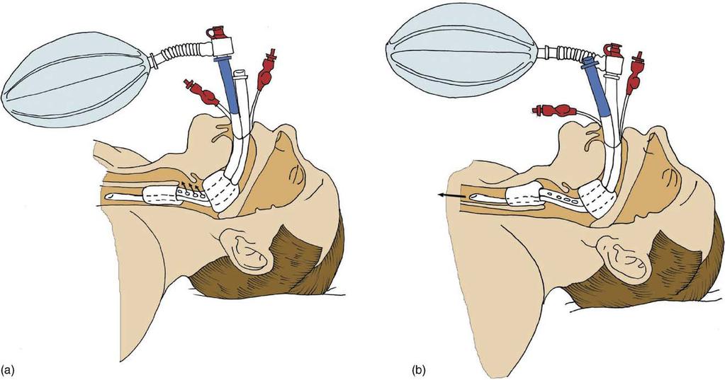 European Resuscitation Council Guidelines for Resuscitation 2005 9 Obr. 4.10 (a) Combirúrka v pažeráku. (b) Combirúrka v priedušnici.