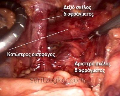 Διακρίνονται και τα δύο σκέλη του διαφράγματος, το τελικό