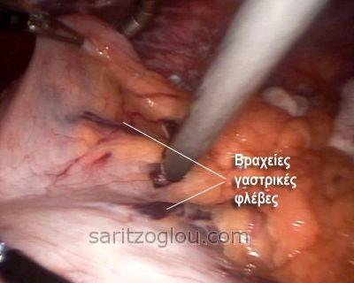Διατέμνονται οι βραχείες γαστρικές φλέβες
