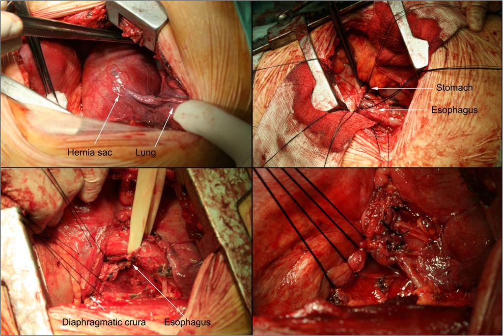 Figure 1 Belsey Mark IV operation. Top left Hernial sac adhering to the lung. Bottom left -Sutures placed between the diaphragmatic crura.