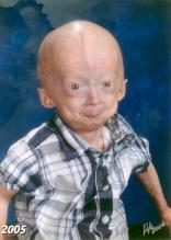 godina Hutchinson-Gillford syndrome ( Progeria ) Nasledni nepolipozni kancer kolona Deficijencija