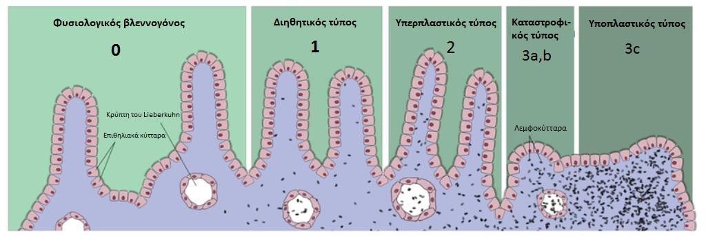 Στην παρακάτω εικόνα (εικόνα 5) απεικονίζονται αδρά οι ιστολογικές αλλοιώσεις του βλεννογόνου του λεπτού εντέρου στην κοιλιοκάκη.