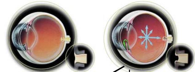 Γλαύκωμα Αυξηση ενδοφθάλμιας πίεσης (>21mmHg)