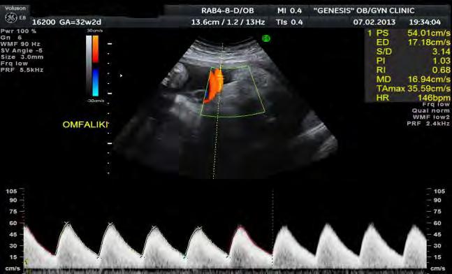 ΚΑΤΕΥΘΥΝΤΗΡΙΕΣ ΟΔΗΓΙΕΣ ΕΕΥΜΓ 7 Εικόνα 56. Έλεγχος Doppler ομφαλικής αρτηρίας Εικόνα 57. Ανάστροφη ροη αίματος ομφαλικής αρτηρίας Δ.
