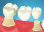 οξέων. Θεραπεία οδοντικής επιφάνειας πριν και µετά τη λεύκανση.