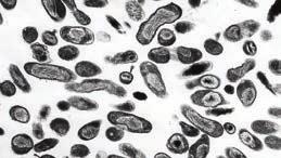 . Ενδοκαρδίτιδα από Coxiella Burnetii (Q fever) με πιθανά μυκωτικά ανευρύσματα και οξεία νεφρική ανεπάρκεια Λίγα λόγια για την ενδοκαρδίτιδα από πυρετό Q (από το Query) O πυρετός Q είναι ζωονόσος,