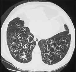 ERS bronchiectasis guidelines PICO question 3- Should we attempt to eradicate pathogenic microorganisms? Recommendations 1. We suggest that adults with bronchiectasis with a new isolation of P.