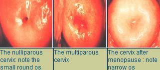 Εικόνα 6: Το σχήμα του τραχηλικού στομίου πριν, μετά από εγκυμοσύνη και μετά την εμμηνόπαυση [8] Ο ενδοτράχηλος εκτείνεται από τον ισθμό (έσω στόμιο) έως τον εξωτράχηλο και περιλαμβάνει τον