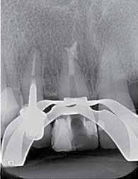 Ενδοδοντία 22 Dental Tribune Greek Edition DT σελίδα 20 ειδικά με μεγαλύτερη διάμετρο, χωρίς προηγούμενη εξέταση της εσωτερικής οδοντικής ανατομίας ως μέρος της θεραπευτικής διαδικασίας, αυξάνει τον