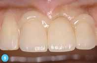 Αρχίζουμε με την ενεργοποίηση του δοντιού χρησιμοποιώντας PANAVIA TM V5 Tooth Primer.
