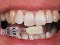 Με τη βοήθεια ενός εκμαγείου μελέτης, προσδιορίστηκε η ιδανική θέση των δοντιών με κερί (εικ. 2) και στη συνέχεια μετατράπηκε σε ένα ομοίωμα με όψεις ρητίνης.