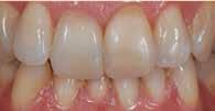 Μετά τον έλεγχο των λειτουργικών κριτηρίων, η ασθενής έφυγε από το οδοντιατρείο (εικ. 13 και 14).