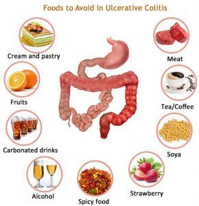 Τα άτομα με ελκώδη κολίτιδα μπορεί να έχουν πρόβλημα με τις παρακάτω τροφές και ποτά: 1. αλκοόλ 2. καφεΐνη 3. αεριούχα ποτά 4. τα γαλακτοκομικά προϊόντα 5. ωμά φρούτα και λαχανικά 6. σπόροι 7.