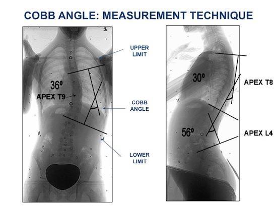 Σκολιωτική γωνία (Cobb angle) Σκολιωτική γωνία (Cobb angle) Σημαντική για την επιλογή της κατάλληλης θεραπείας και την πρόγνωση Most tilted upper end vertebra most tilted lower end