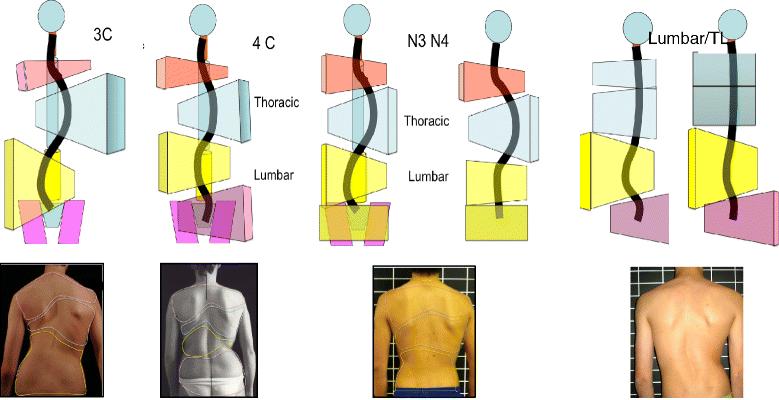 Schroth Barcelona Scoliosis Physical Therapy School (BSPTS) Κλινική και ακτινολογική