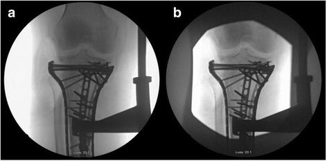 Intraoperahve radiahon safety in orthopaedics: a