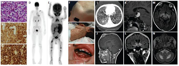 Langerhans Cell Histiocytosis: Emerging Insights