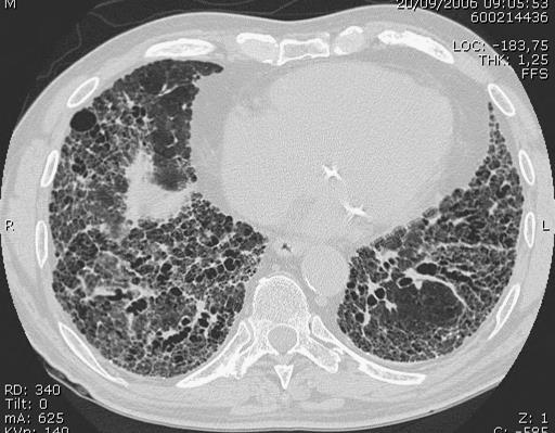 surgical lung biopsy c)specific combinations of HRCT and surgical lung biopsy